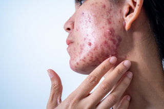 Acne Awareness Month: Why CLn Acne Cleanser Is a Staple for Clearer Skin